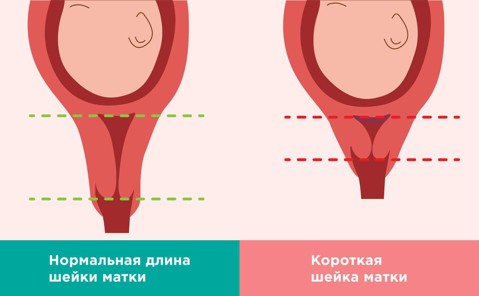 Короткая шейка матки при беременности: причины патологии, лечение, роды
