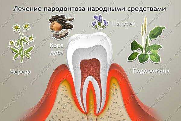 Лечение пародонтоза в домашних условиях: как лечить дома быстро и эффективно, чем вылечат симптомы раз и навсегда, зубы шатаются