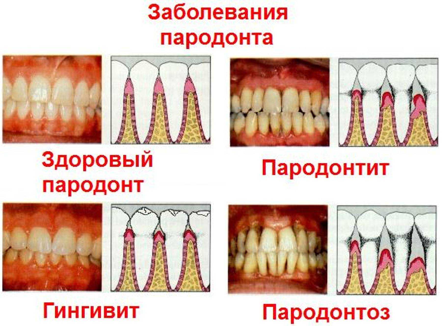 Удаление парадонтозных зубов |