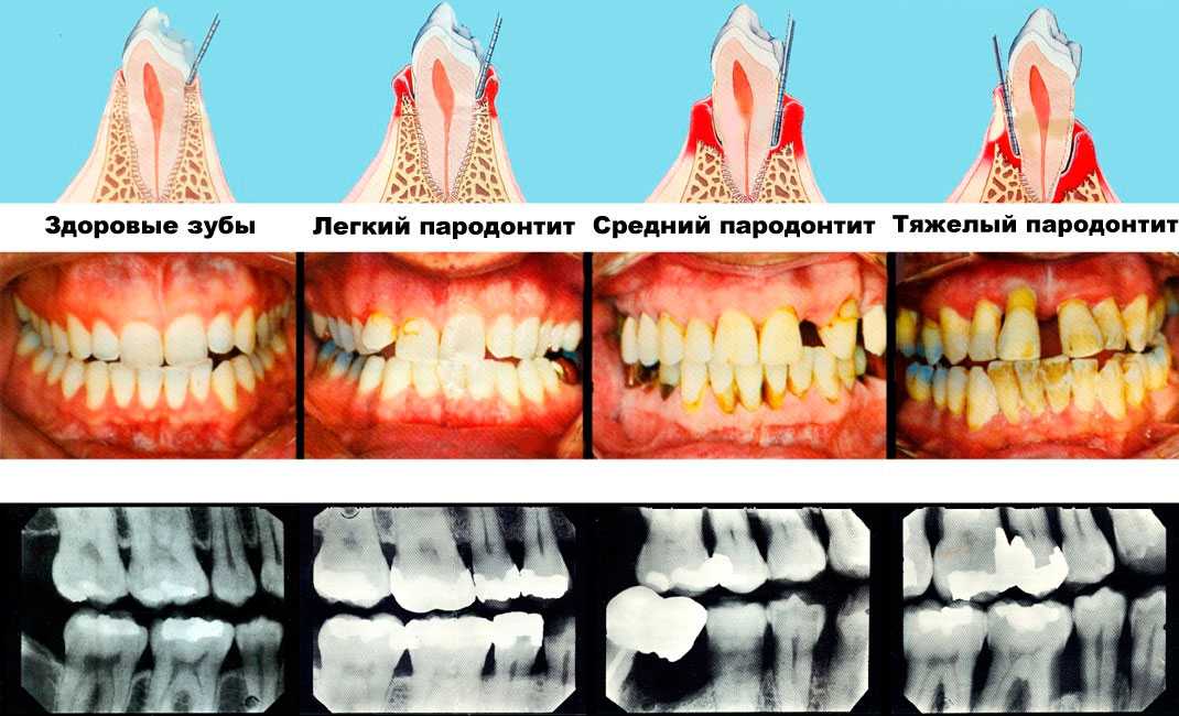 Варианты протезирования при пародонтите и пародонтозе | стоматологическая клиника кристалл