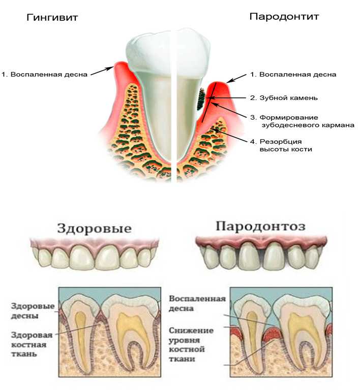 Лечение пародонтоза, причины, симптомы и фото зубов, профилактика
