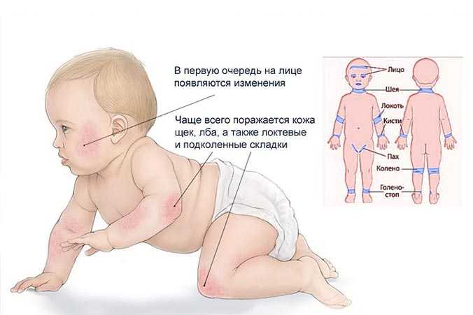 Почему на теле и лице у новорожденного или грудного ребенка появилась сыпь в виде мелких прыщиков: фото с пояснениями
