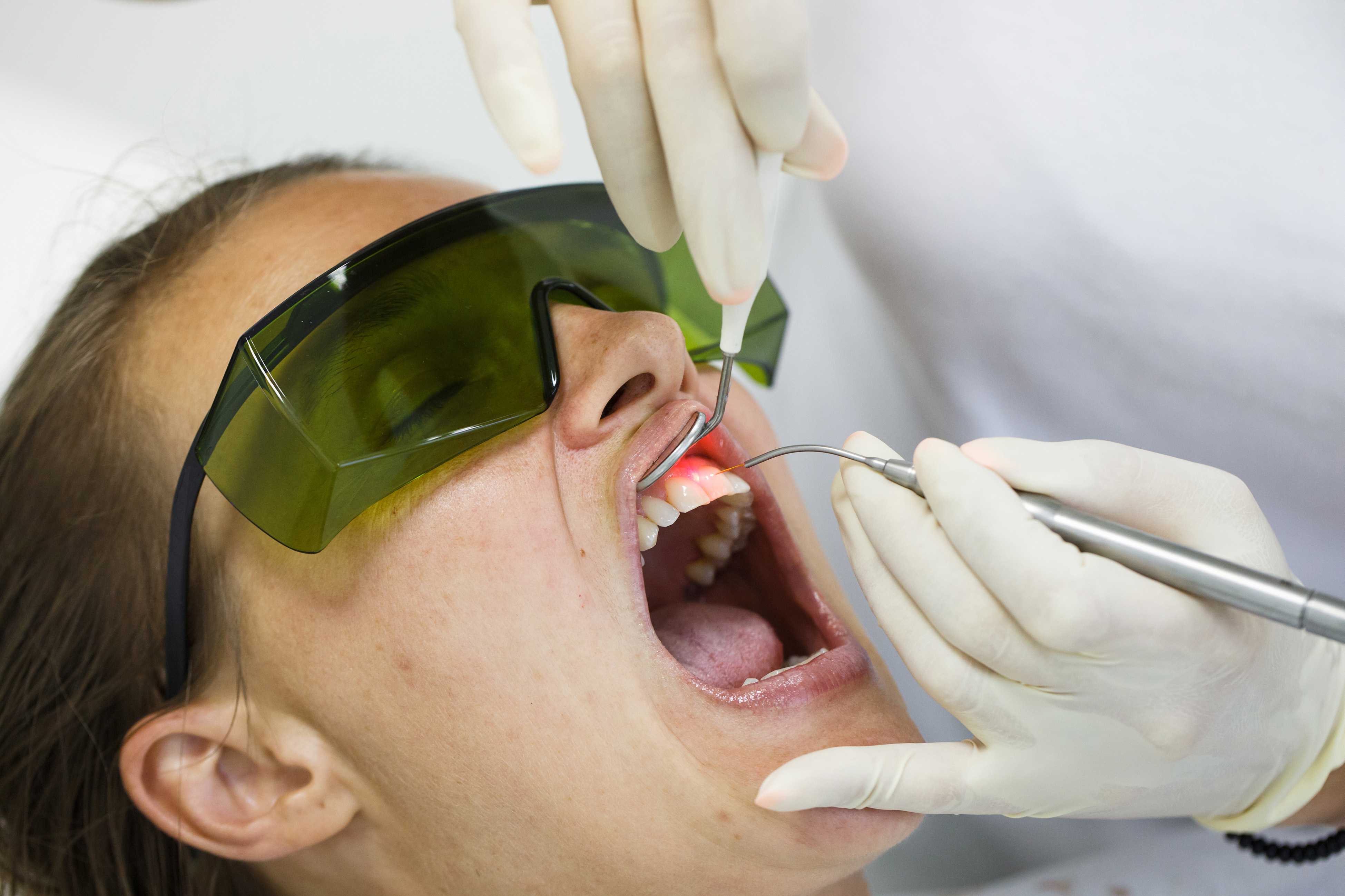 Удаление парадонтозных зубов