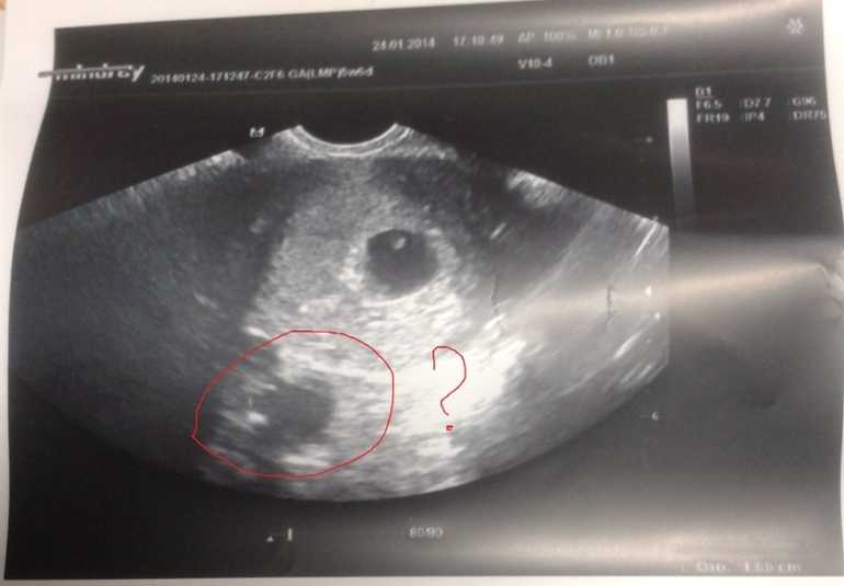 Первые признаки беременности двойней на раннем сроке