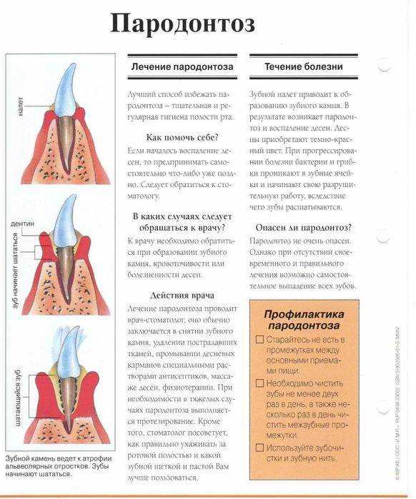 Пародонтоз: признаки, стадии, лечение |  | стоматология вита-дент