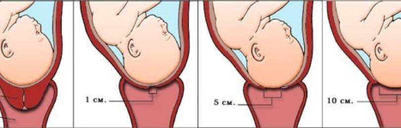Причины и лечение короткой шейки матки при беременности