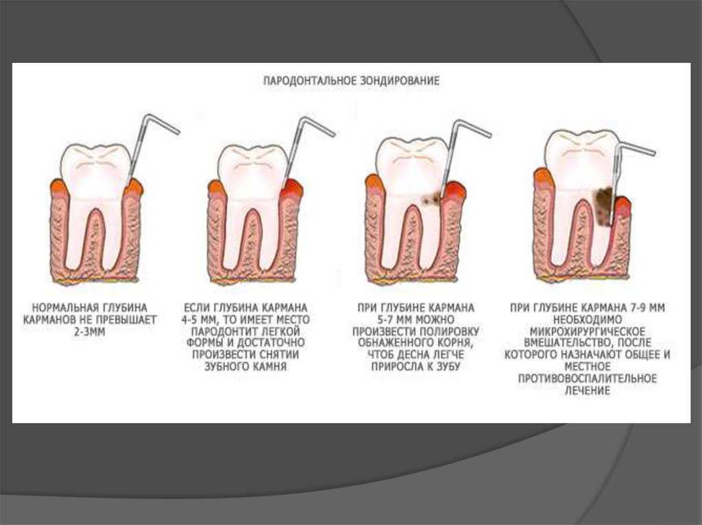 Пародонтоз - причины и лечение | стоматология 24
