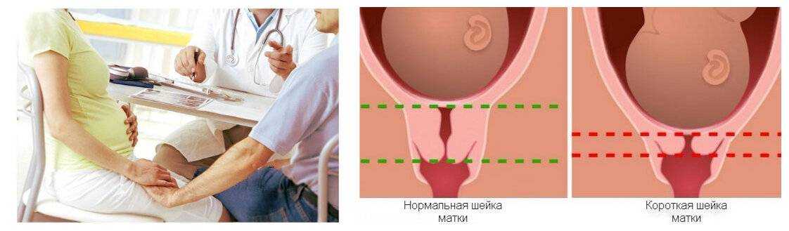 Шейка матки при беременности: короткая, длинная, укороченная