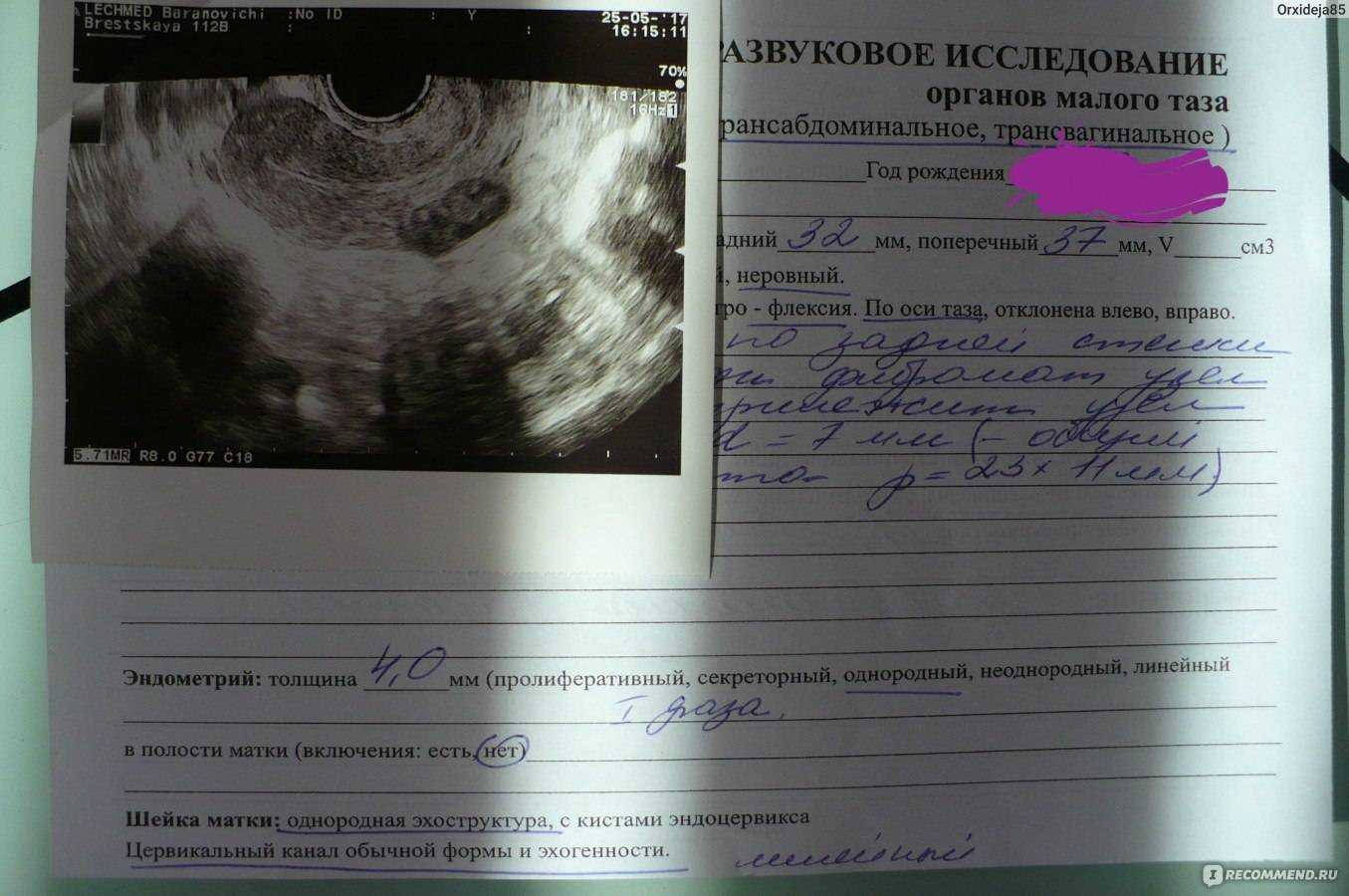 Фолликулометрия: показания, подготовка, проведение, результаты • центр гинекологии в санкт-петербурге