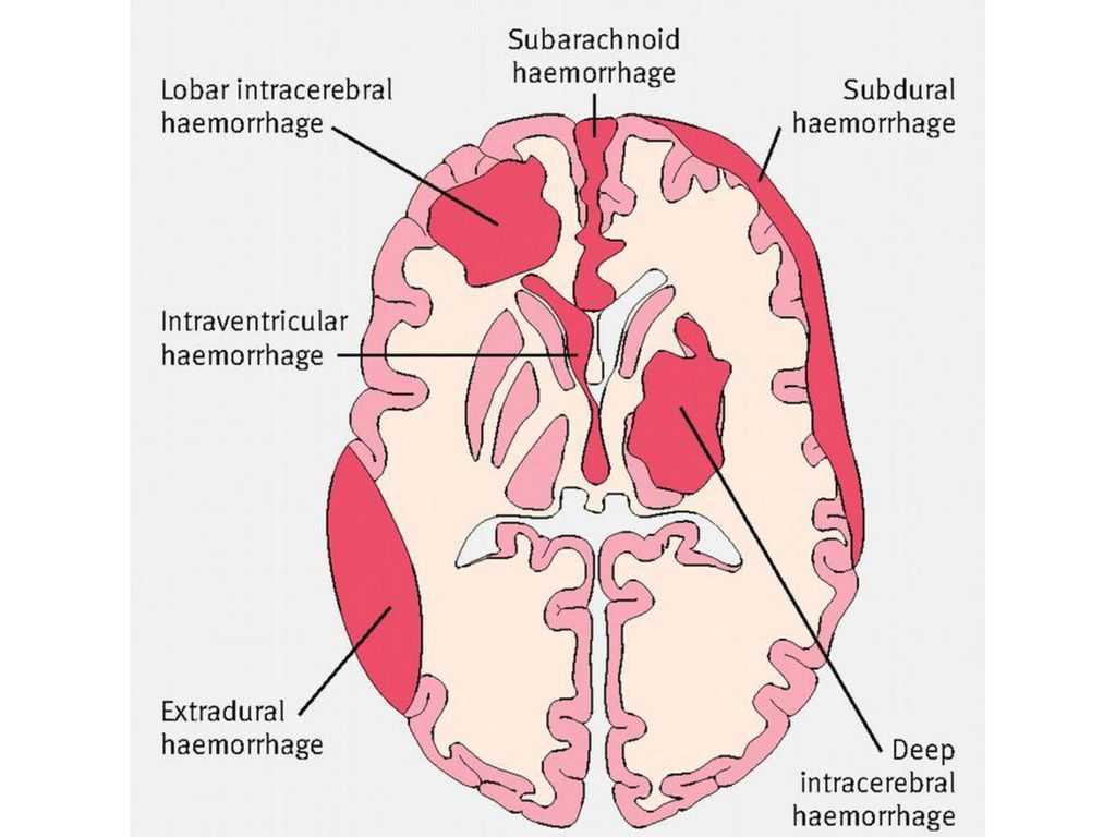 Субарахноидальное кровоизлияние