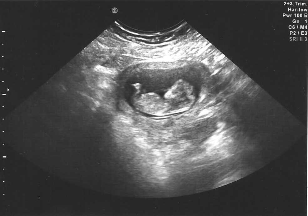 11 неделя беременности - первое узи, фото животика, как выглядит ребенок, растяжки, варикоз