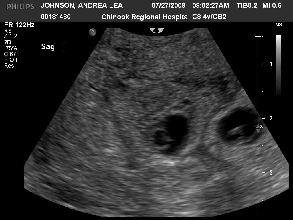 Узи двойни при беременности: фото на ранних сроках в 5-6 недель и позже