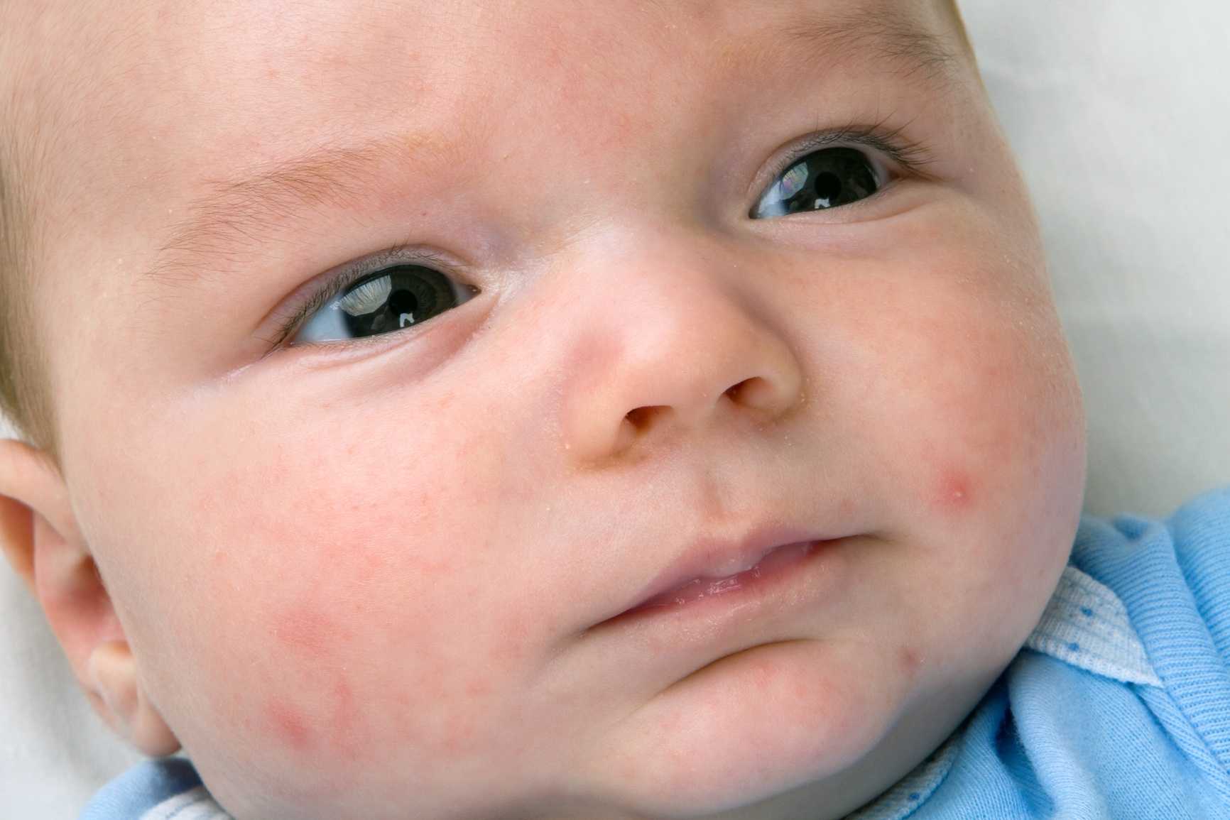 Белые точки на носу у новорожденного ребенка - что это и почему они появляются?
