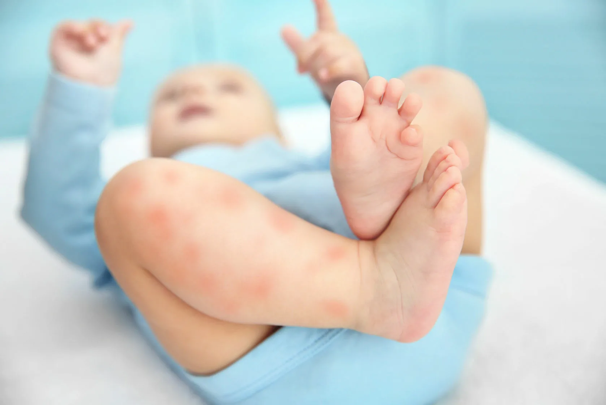 Сыпь у новорожденного или грудного ребенка в виде мелких прыщиков на лице и теле, фото с пояснениями