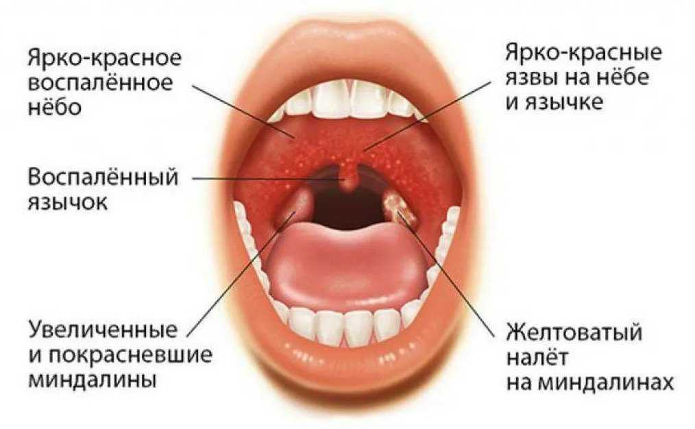 Ангина герпетическая: 5 особенностей течения и лечение у детей