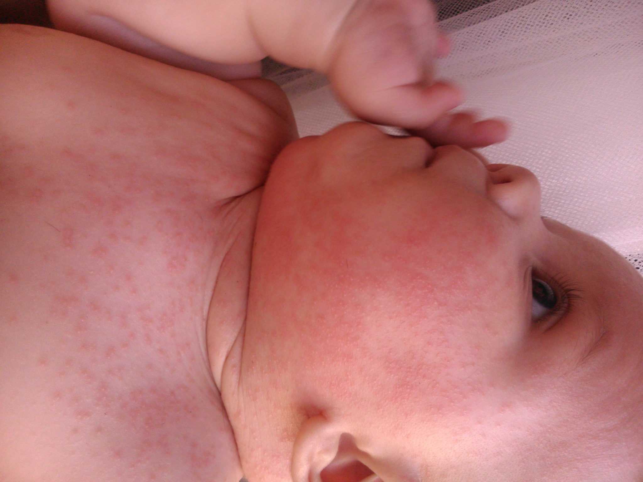 Белые точки на носу у новорожденных