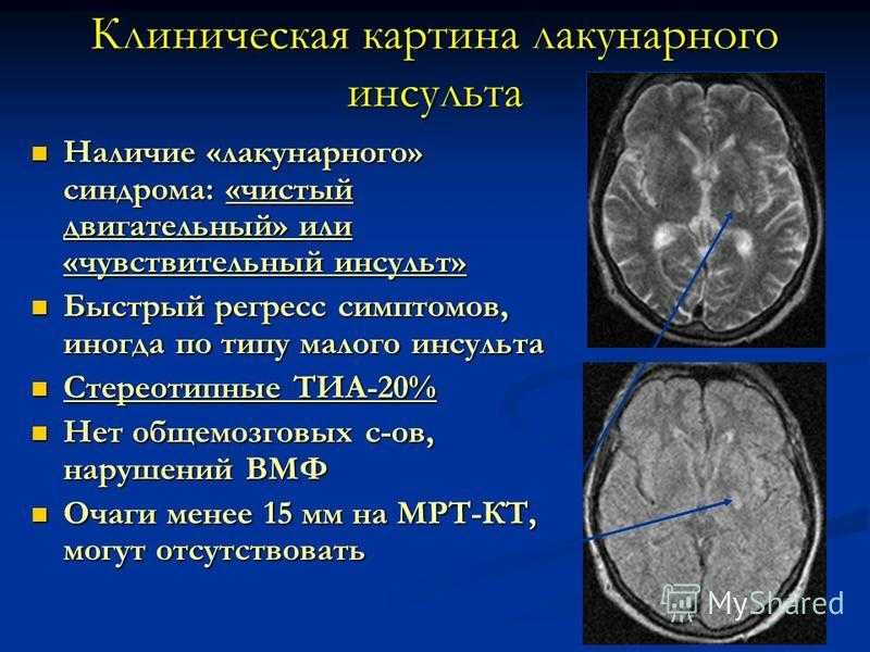 Лакунарный инсульт: причины, симптомы и последствия. все, что нужно знать