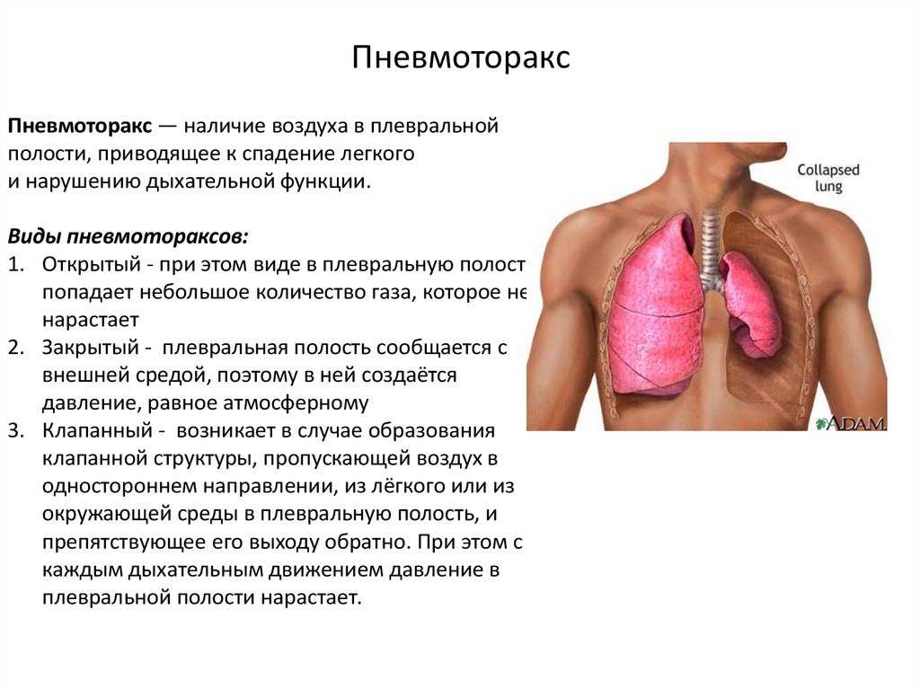 Разрыв легкого – причины, симптомы и последствия