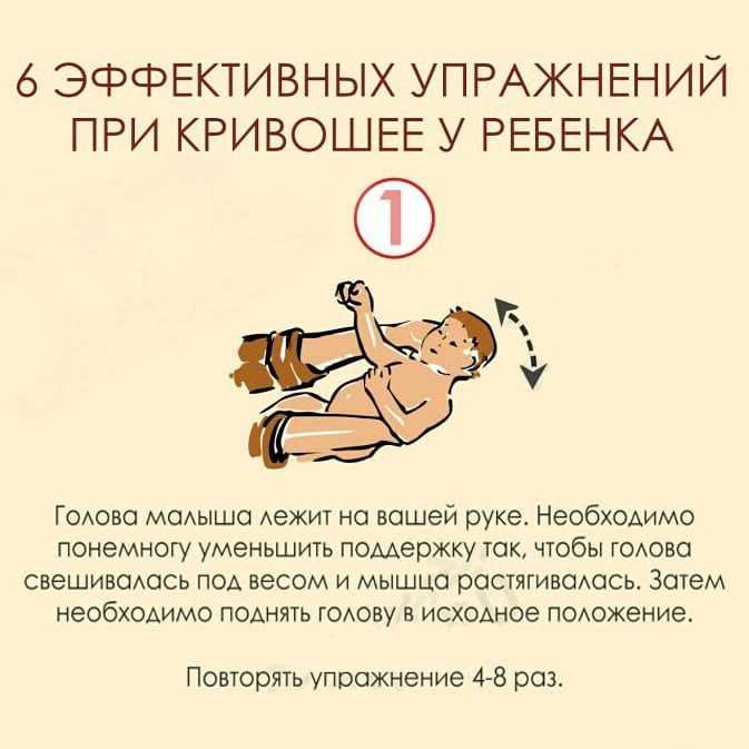 Кривошее у новорождённых, что делать