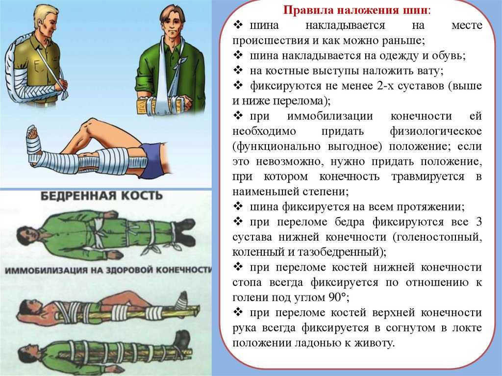 Наложение шины: виды и основные правила