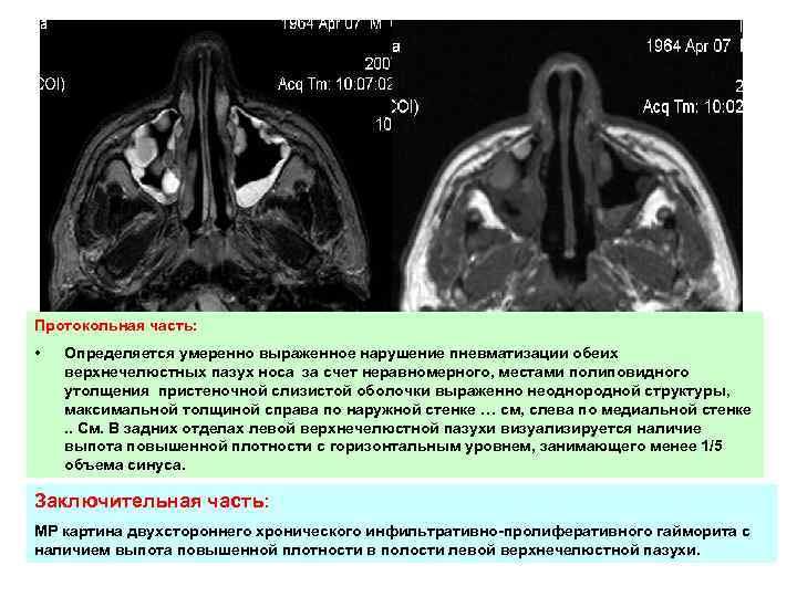 Пневматизация пазух носа: о чем говорит повышение, снижение | za-rozhdenie.ru