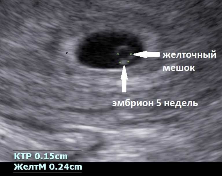 Анэмбриония - прозвучало как приговор! - страна мам