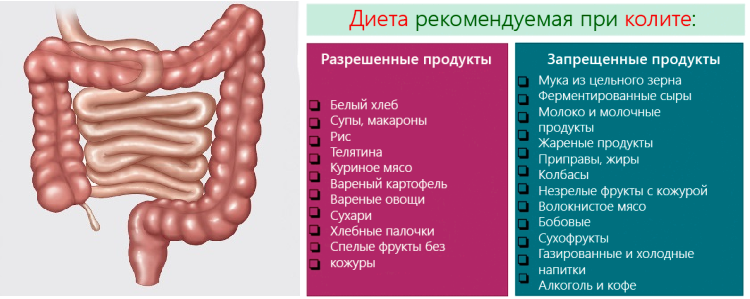 Запоры при долихосигме