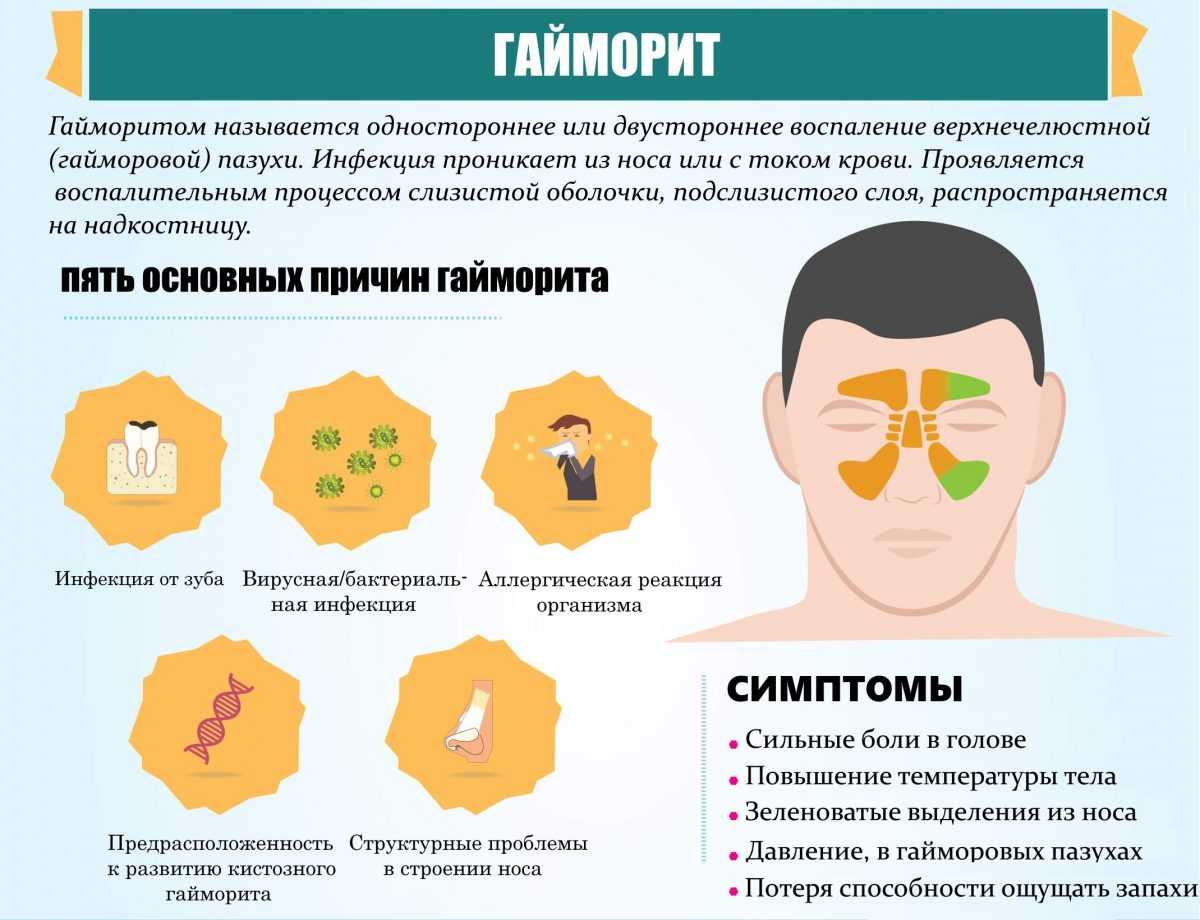 Гайморит - симптомы, причины, лечение и профилактика у взрослых и детей