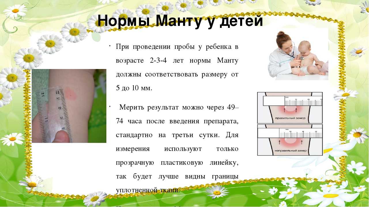 На какой день проверяют манту у ребенка: через сколько времени и как должна выглядеть? | prof-medstail.ru