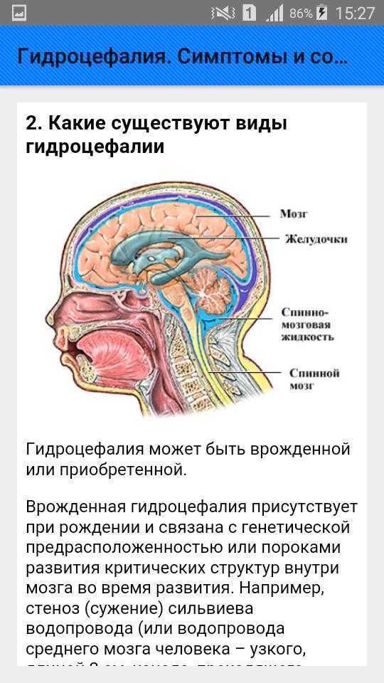 Гидроцефалия (“водянка мозга”): как развивается, формы, проявления, лечение, последствия