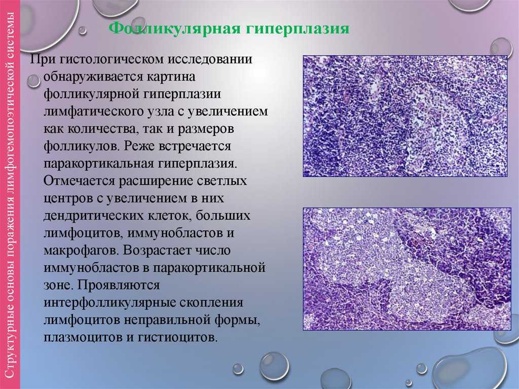 Гиперплазия желудка: фовеолярная, очаговая, полиповидная