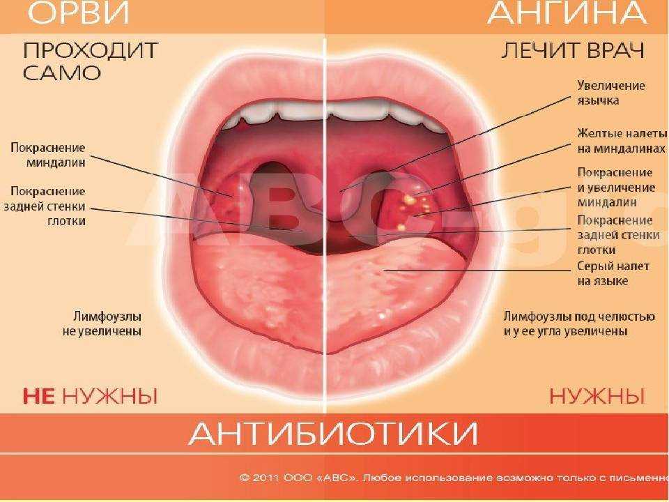 Стоматит в горле: симптомы и лечение - как лечить на гландах и гортани у взрослых - эффективные препараты, если болит
