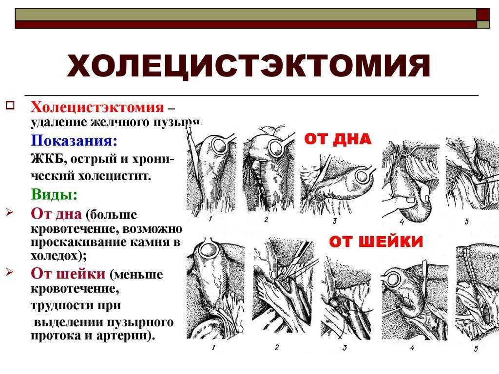 Литоэкстракция в международной клинике медика24