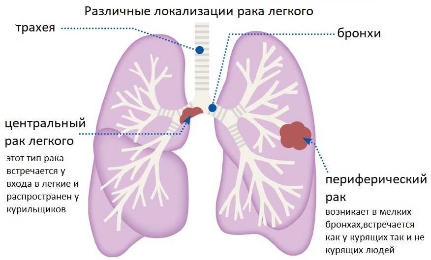Предоперационная подготовка при ранениях: дренирование плевральной полости