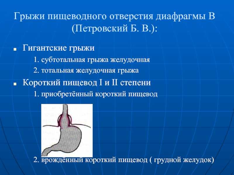 Грыжа пищеводного отверстия диафрагмы