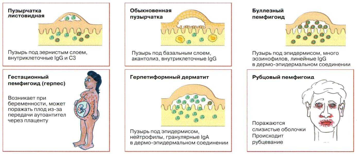 Облучение базалиомы (лучевая терапия, лучевое лечение).