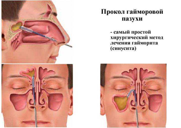 Острый и хронический синусит (гайморит, фронтит, этмоидит)
