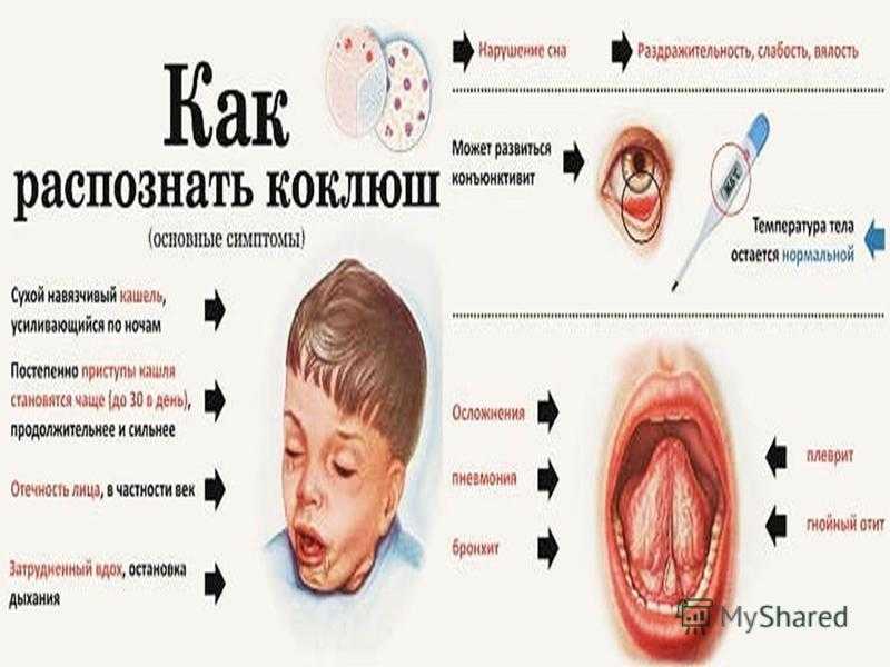 Кашель при коклюше, как облегчить кашель при коклюше у детей, видео