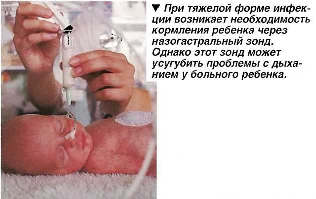 Кормление недоношенных детей