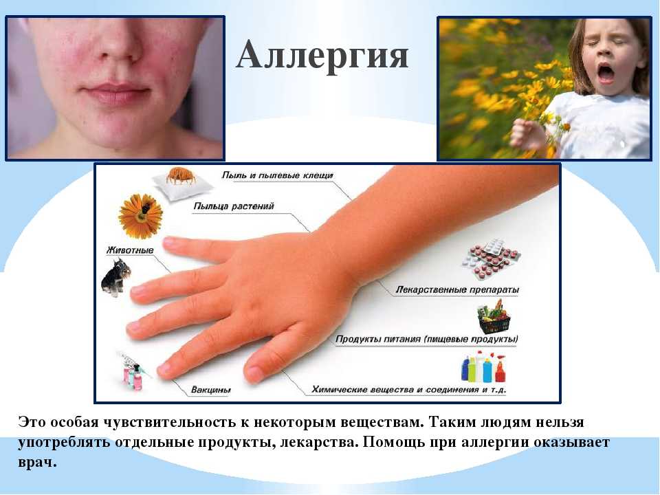 Чем опасна аллергия — последствия у детей и взрослых 2024