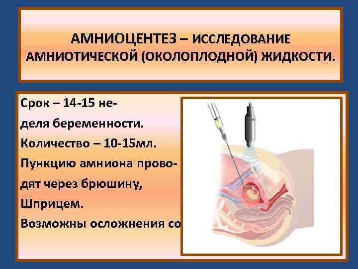 Амниоцентез