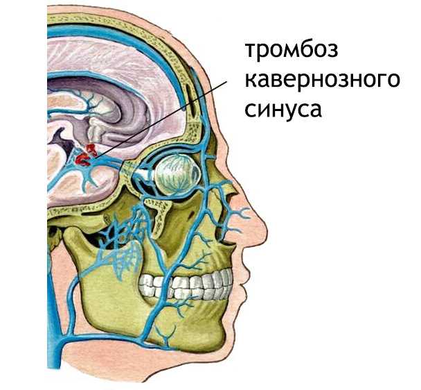Причины появления тромба в голове, диагностика и лечение