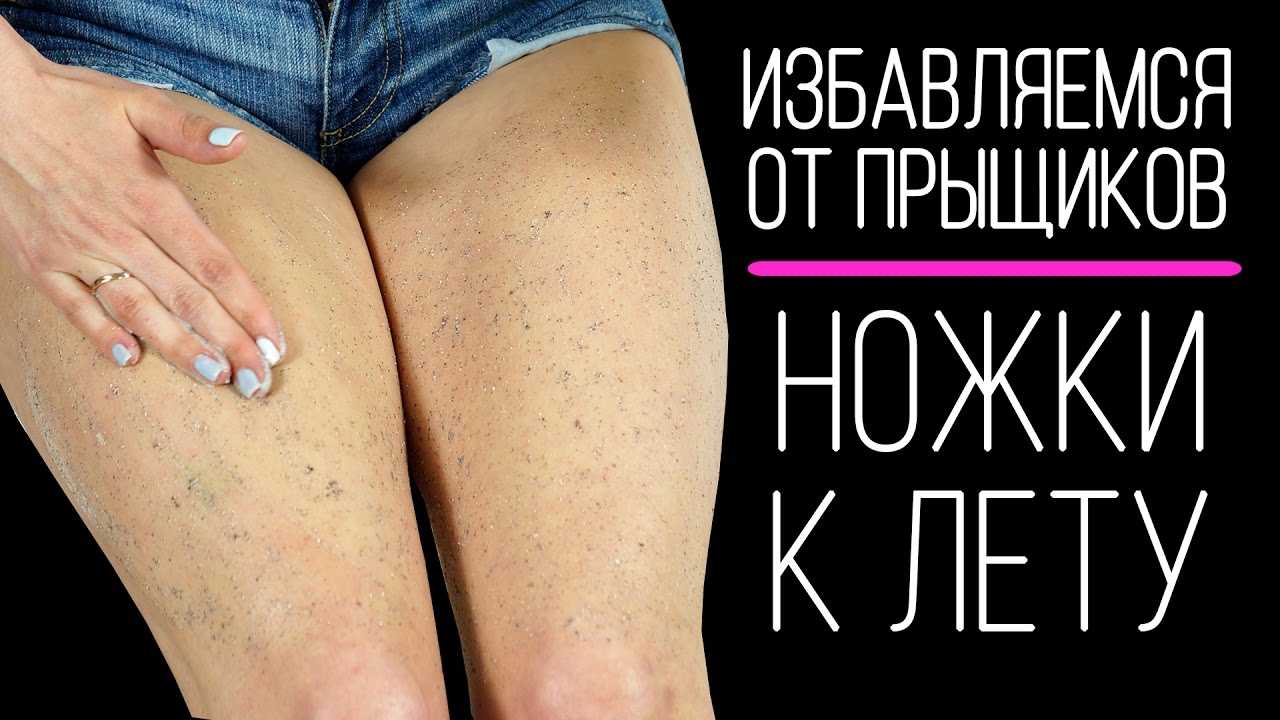 От чего появляются прыщички на попе, и как от них избавится: советы для девушек