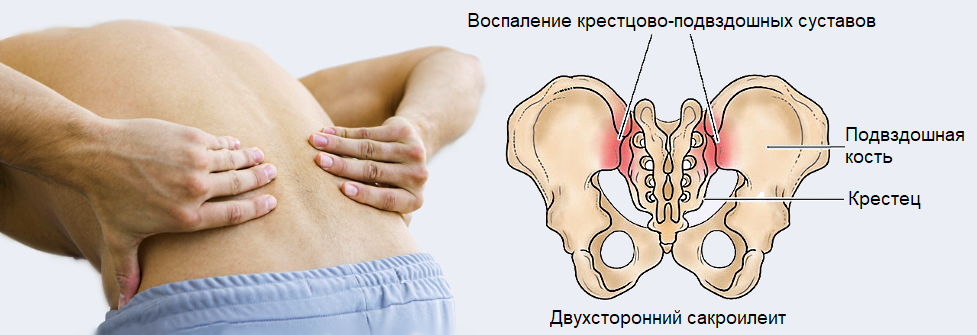 Болит крестец и отдает в ногу: причины, симптомы, лечение