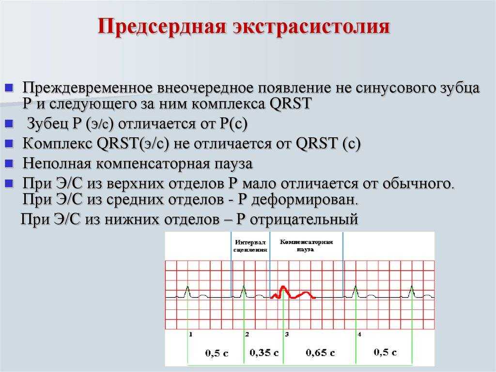 Экстрасистолы