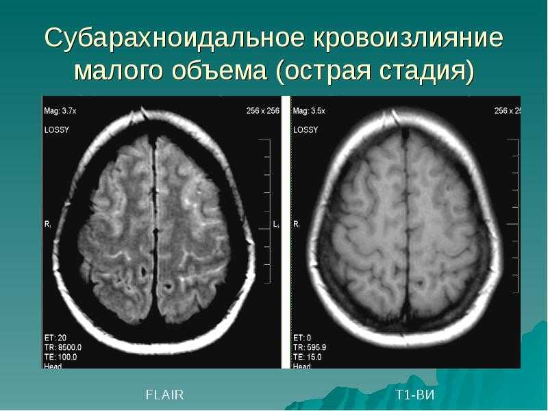Что такое субарахноидальное пространство и почему возникает его расширение — med-anketa.ru