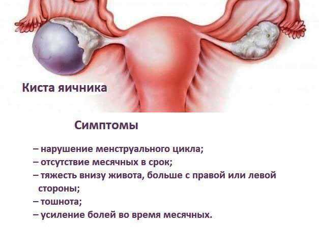 Опухоли яичников (кисты и кистомы): что это, симптомы, причины образования, классификации, диагностика, лечение и рекомендации женщинам - клиника нкц №2 (цкб ран)