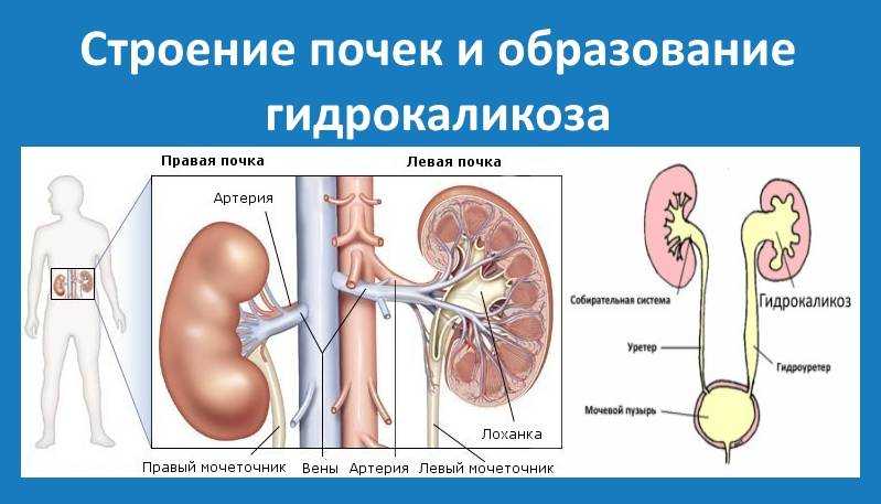 Каликоэктазия почек: причины, симптомы, лечение