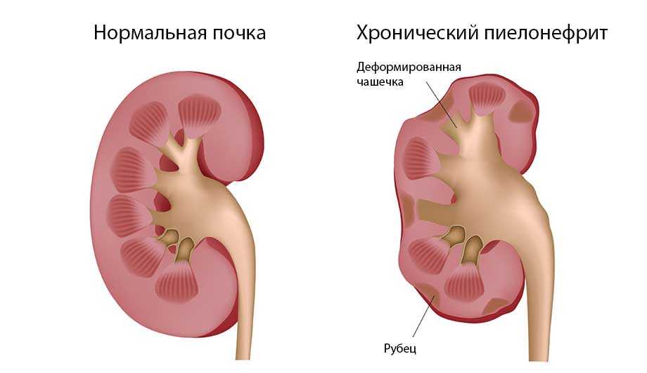 Застуженные почки у мужчин симптомы признаки и лечение