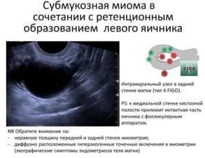 Миома матки и возможности ее лечения